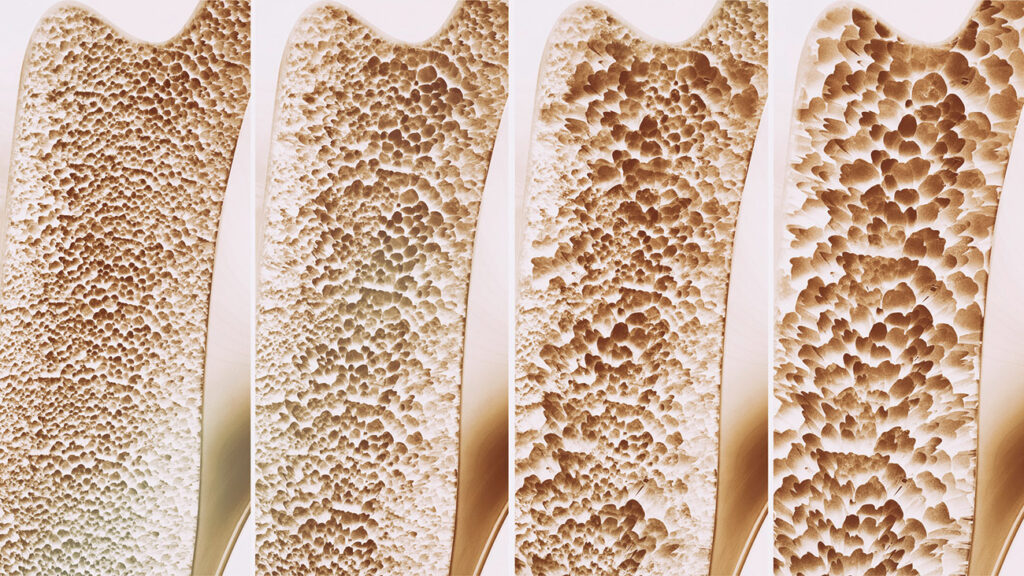 Focus benessere della donna.
Vitamina D.
Osteoporosi.
radiazioni solari UVB.

